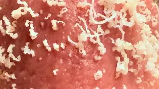 Top video remove black heads part 13