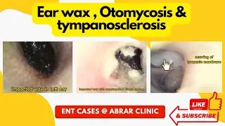 Ear wax removal | otomycosis | tympanosclerosis & chorda tympani