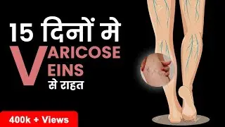 What are Varicose Veins? | Get rid of Varicose Veins in Just 15 Days | Fitnesswithgomzi