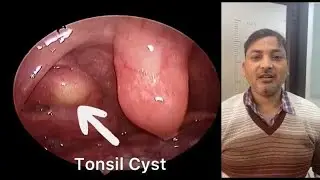Tonsil Cyst : Cause of pain and burning in throat.
