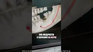 Удаляем самые сложные зубы мудрости бережно и безболезненно, с использованием лучших анестетиков 🙌