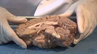 The Ventricles: Neuroanatomy Video Lab - Brain Dissections