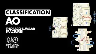 AO Classification Thoracolumbar Fractures