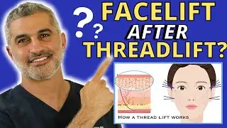 Can you get a Facelift after getting Threadlifts? Facial Plastic Surgeon Answers