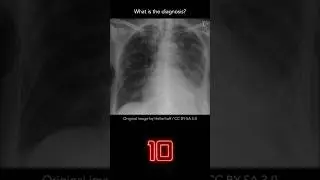 Chest X-ray Quiz 17 (explanation with overlays)