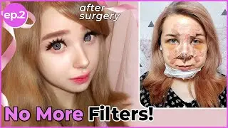 [SUB] Rhinoplasty with NO Silicone Implant, Genioplasty (V-line), and Fat Grafting for Barbie Face!