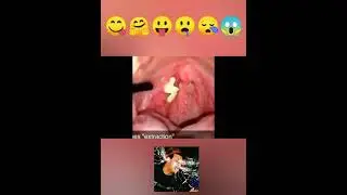 давим огромные прыщи. прыщи в горле. жесть!!!