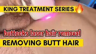 Butt Laser Hair