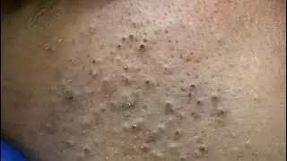 Deep Pore Cleansing | Blackheads and Pimples Removal