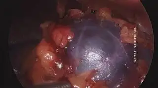 SA-25 LAPAROSCOPIC TRANSPERITONEAL RENAL CYST EXCISION. SERDAR AYKAN,MD