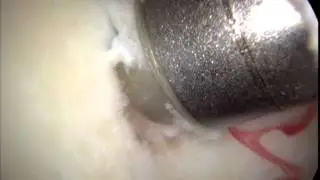 Articular Cartilage Paste Grafting Surgical Technique performed by Kevin R. Stone, MD