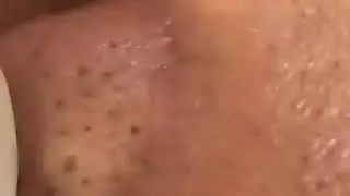 Удаление Угрей, Удаление Прыщей,