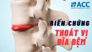 Bệnh thoát vị đĩa đệm có nguy hiểm không?