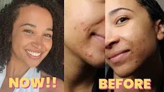 MY ACNE IS GONE! Here’s what I’ve changed!