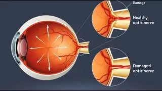 How long does it take to go blind from glaucoma