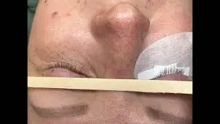 ОПУЩЕНЫЙ внешний угол.