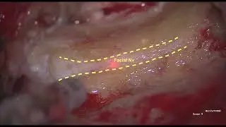 Lateral temporal bone resection (LTBR) with facial nerve sacrifice