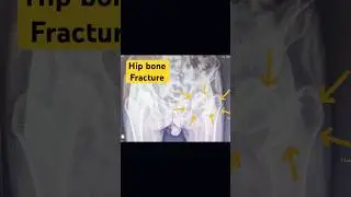 #hemiarthroplasty #modular #bipolar #hip #replacement #trending #reels #song #taubatauba