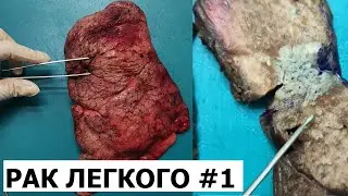 Периферический рак легкого #1 - гистологическое исследование (вырезка)