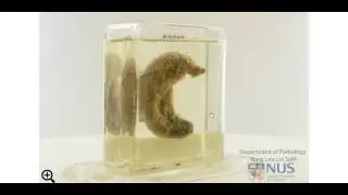 Acute appendicitis: Gross pathology