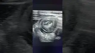 Donut sign- Intussusception on USG