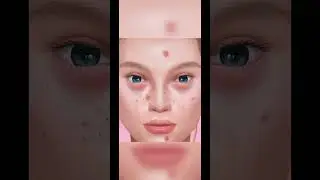 ASMR Acne Removal Treatment 