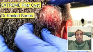 Exploding Cyst, Pilar. Dr Khaled Sadek. LipomaCyst.com