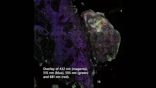 Single-photon image of human melanoma