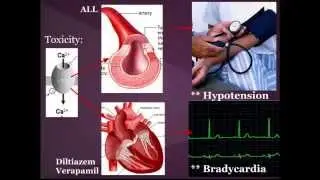 Calcium Channel Blocker (CCB) Toxicity:  