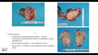 Penis: Squamous cell carcinoma (Gross pathology)