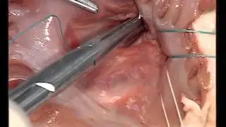 Tricuspid Valve Repair