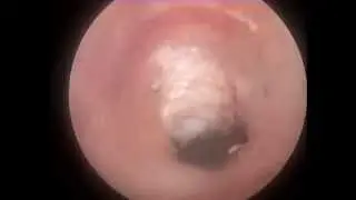 Отоскопия. Otoscopy