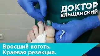 Вросший ноготь. Операция краевая резекция с применением радиоволны.