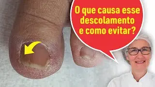 UNHA COM DESCOLAMENTO NAS LATERAIS