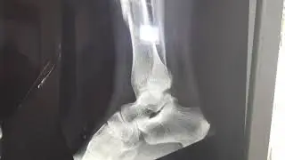 Análise de imagem radiológica de fratura de tibia e fibula 