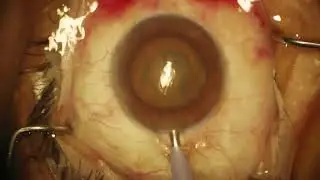 Surgery: Phacoemulsification: Dr. Stephen Lane