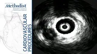 Wallstent Placement for May Thurner Syndrome (Alan B. Lumsden, MD, Ross G. McFall, MD)