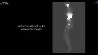 PSMA PET/CT F-18 Case 9
