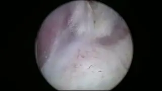 Real-life ThuLEP number 3: bulky prostate, fast operation