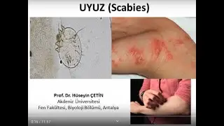 Uyuz nedir? Belirtileri nelerdir? Uyuz için ev ilaçlanmalı mıdır? (Prof. Dr. Hüseyin ÇETİN)