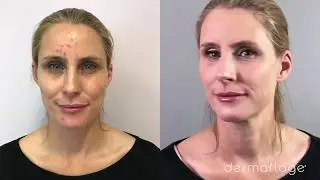 Acne Concealer Tutorial - Watch Dermaflage Founder Cover a Break Out
