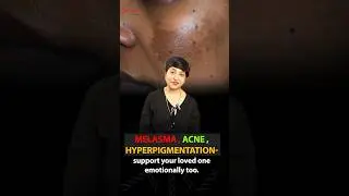 Acne, Melasma, Hyperpigmentation | How Skin Problems Can Lead to Depression |Support & Understanding