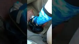 wiggling toes in leg cast