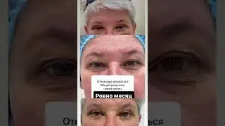 Блефаропластика ташкент верхние нижние веки ровно через месяц вопросы по  +998998850724 dr. Lola