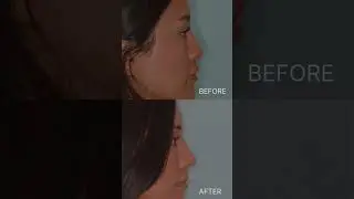 Creating a gentle slope | Anthony Bared MD, FACS | Miami, FL