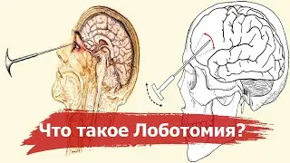 Lobotomy - the nightmare of the 20th century | The history of the most terrible operation