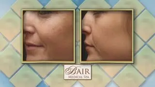 Get a Youthful Glow with Bair Medical Spa: FotoFacial RF