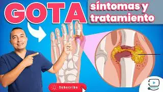 Gota y Ácido Úrico ¿Qué Debes Evitar para No Empeorar la Situación?