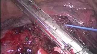 VATS Posterior Segmentectomy of the Right Upper Lobe