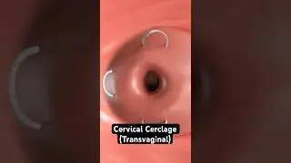 Stitching the cervix to prevent miscarriage (3D animation